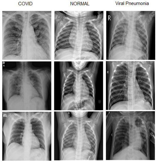 Applied Sciences Free FullText COVID19 Diagnosis in Chest Xrays