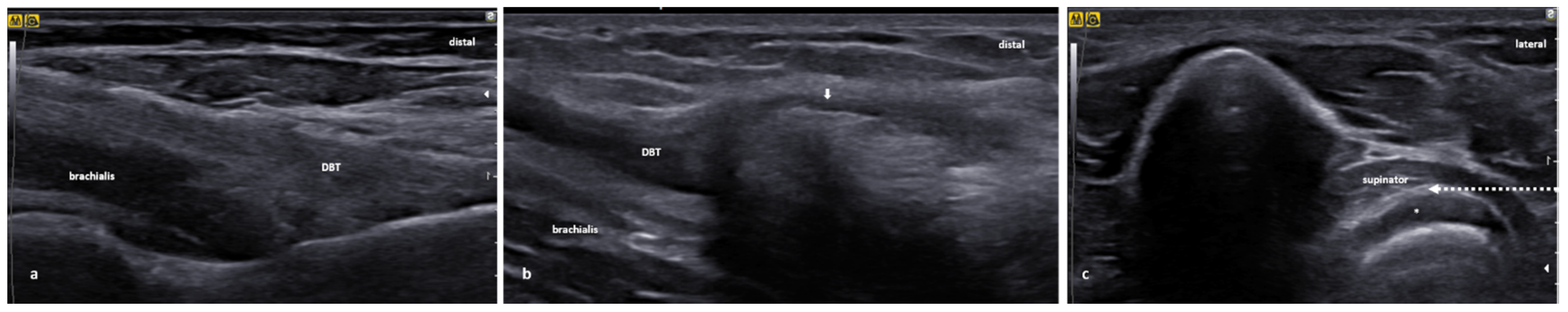 Applied Sciences Free Full Text Ultrasound Guided Procedures In Common Tendinopathies At The Elbow From Image To Needle Html