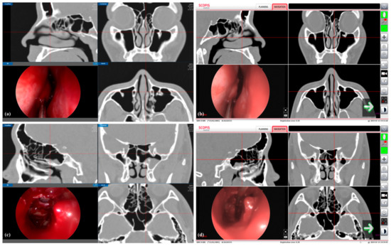 Image-Guided Endoscopic Sinus Surgery with 3D Volumetric Visualization of the Nasal Cavity and Paranasal Sinuses: A Clinical Comparative Study Image-Guided Endoscopic Sinus Surgery with 3D Volumetric Visualization of the Nasal Cavity and Paranasal Sinuses: A Clinical Comparative Study