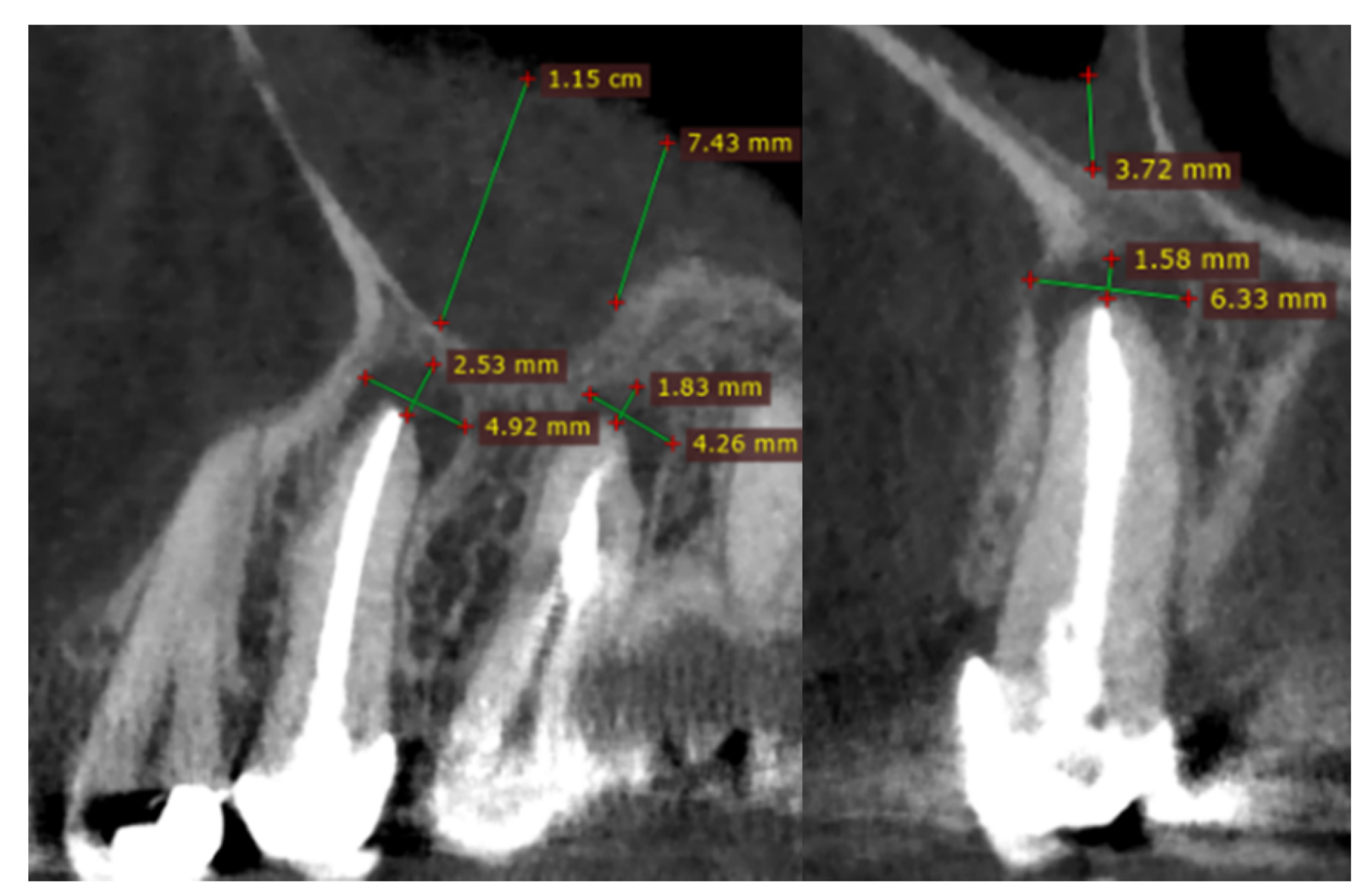 Representative images of a (A) 3-mm and (B) 6-mm apical plug and