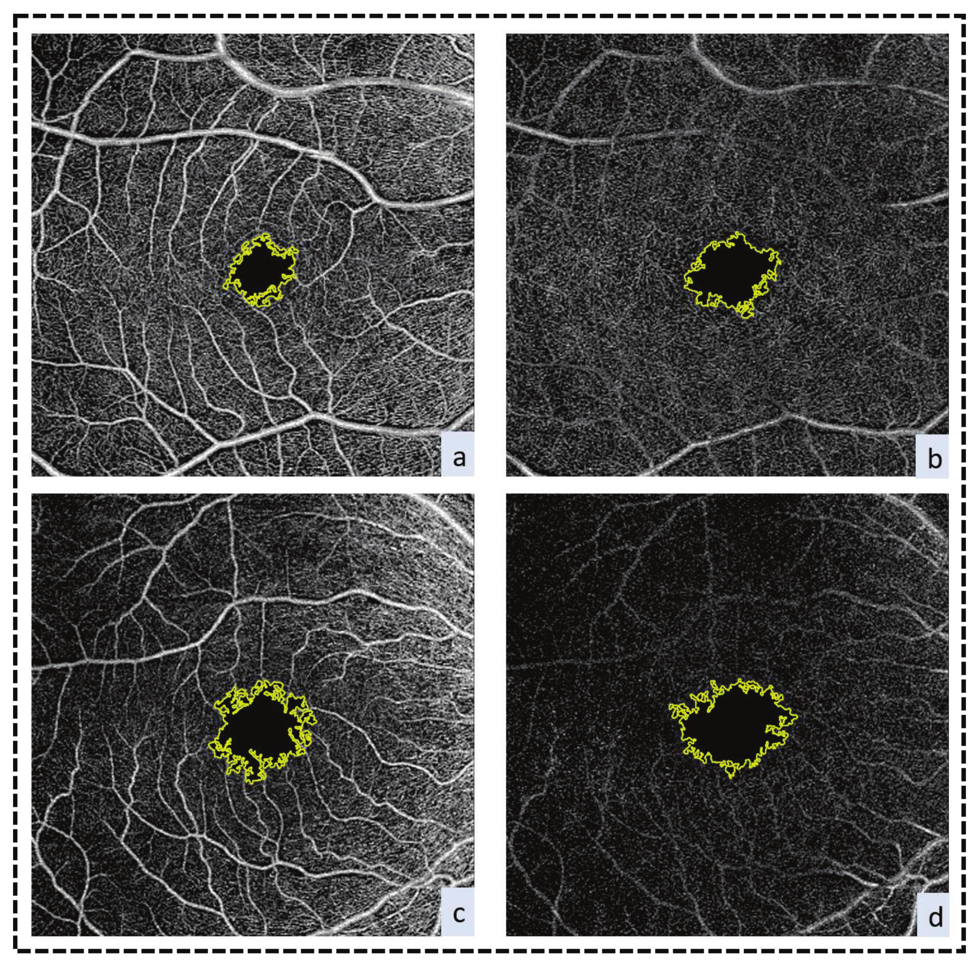 Applied Sciences Free Full Text A Comprehensive Review Of Retinal Vascular And Optical Nerve Diseases Based On Optical Coherence Tomography Angiography Html Applied Sciences Free Full Text A Comprehensive Review Of Retinal Vascular And Optical Nerve Diseases Based On Optical Coherence Tomography Angiography Html