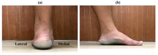 Biomechanical Effect of 3D Printed Foot Orthoses in Patients with Knee Osteoarthritis