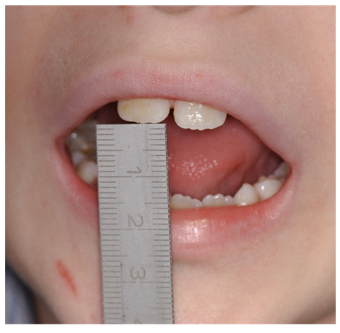 Coronoid process of mandible