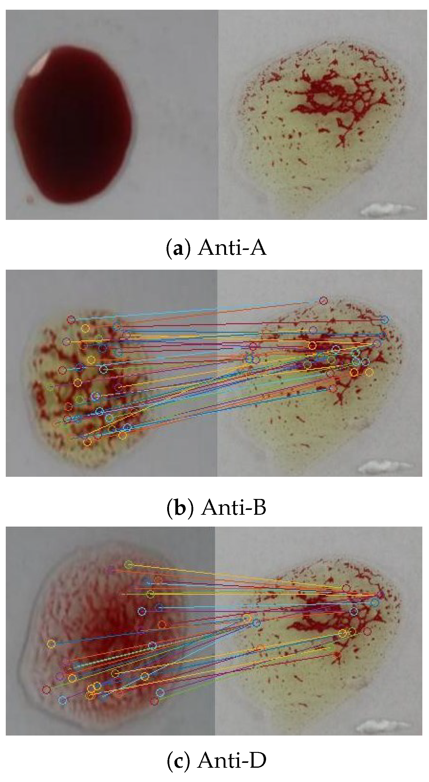 An Efficient System for Automatic Blood Type Determination Based on ...
