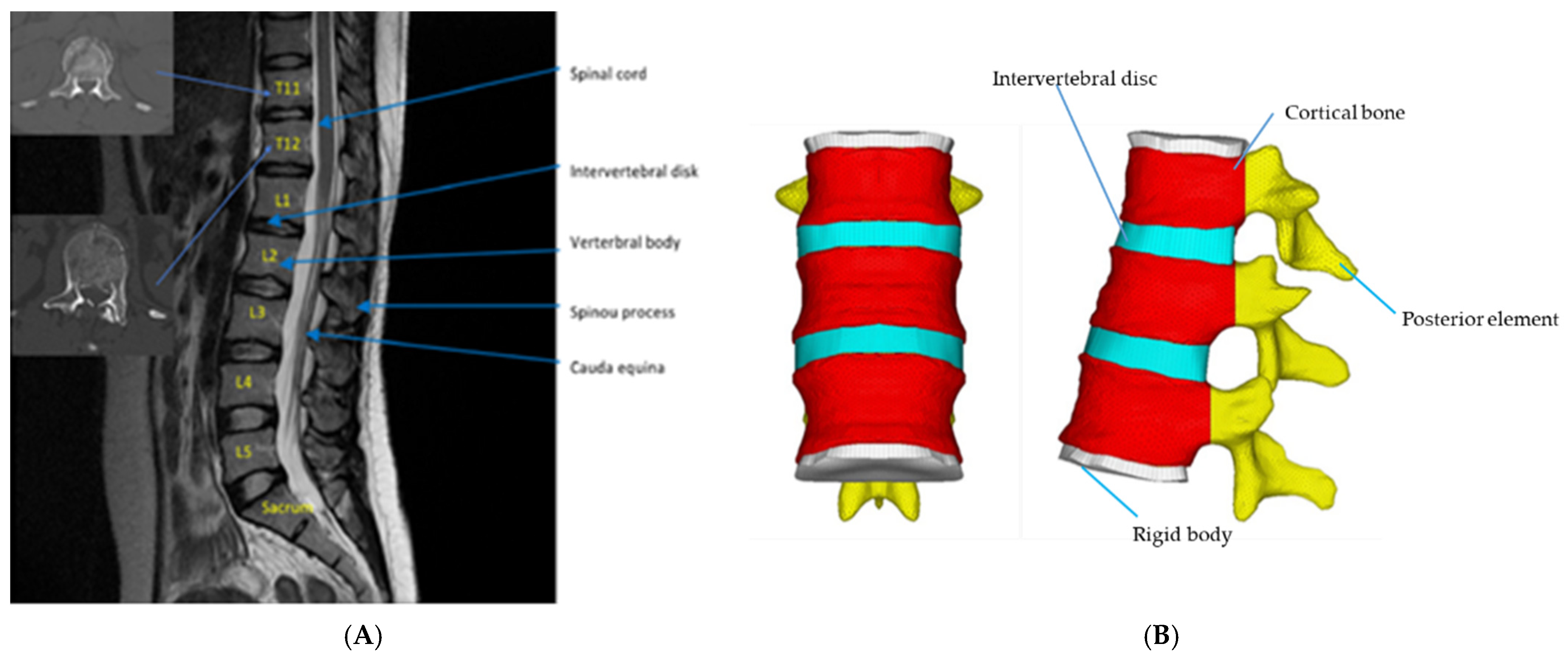 Biomechanical Comparison of Vertebroplasty, Kyphoplasty