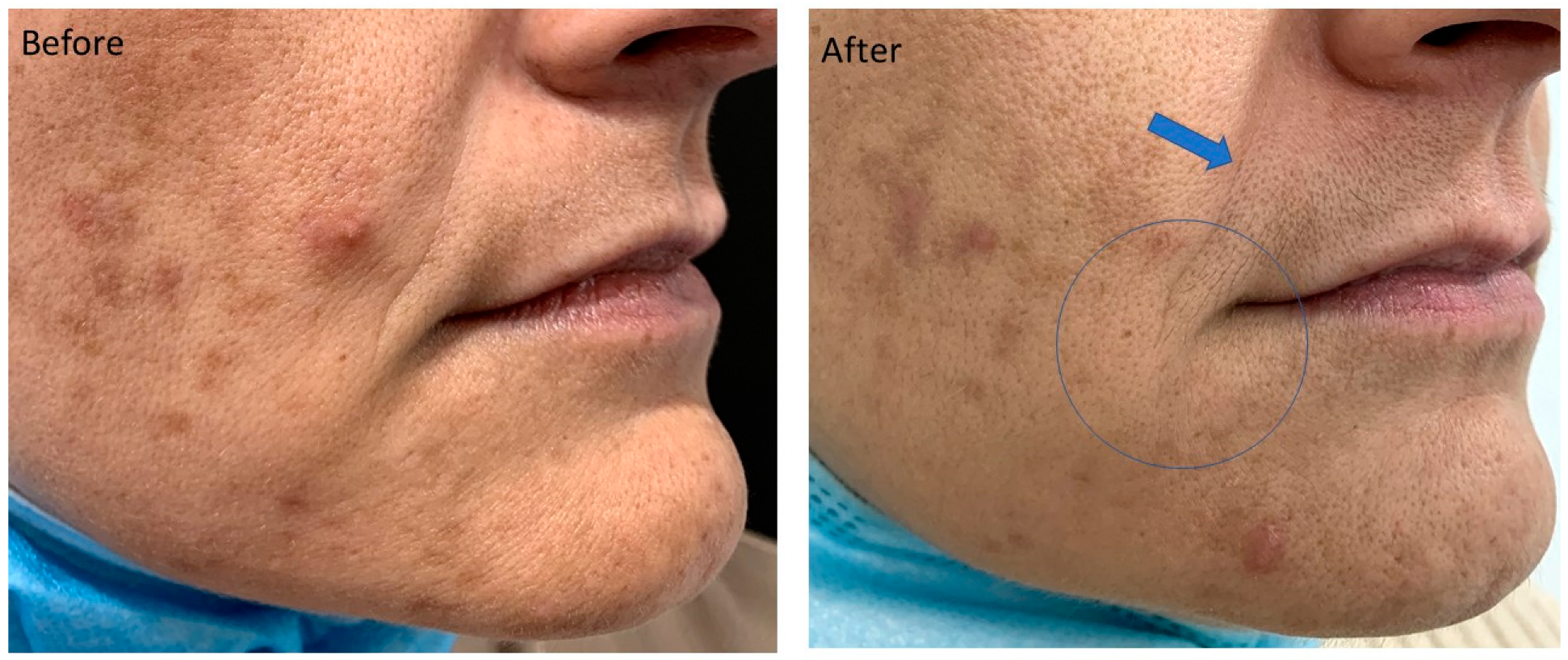 anti aging arc peeling