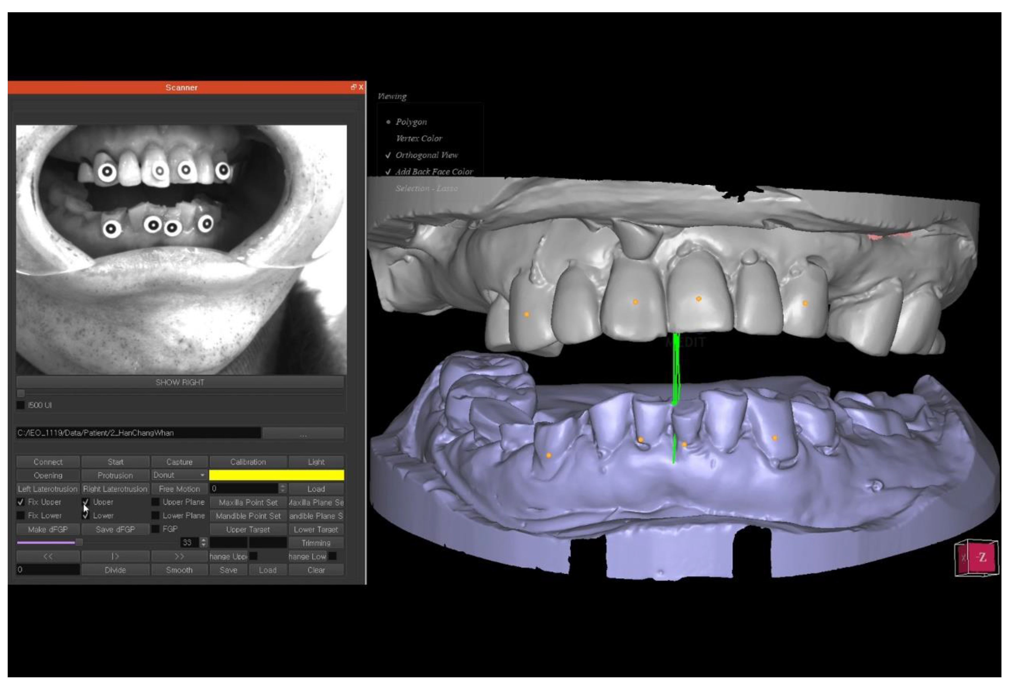 Applied Sciences Free FullText Alteration of the Occlusal Vertical Dimension for Prosthetic