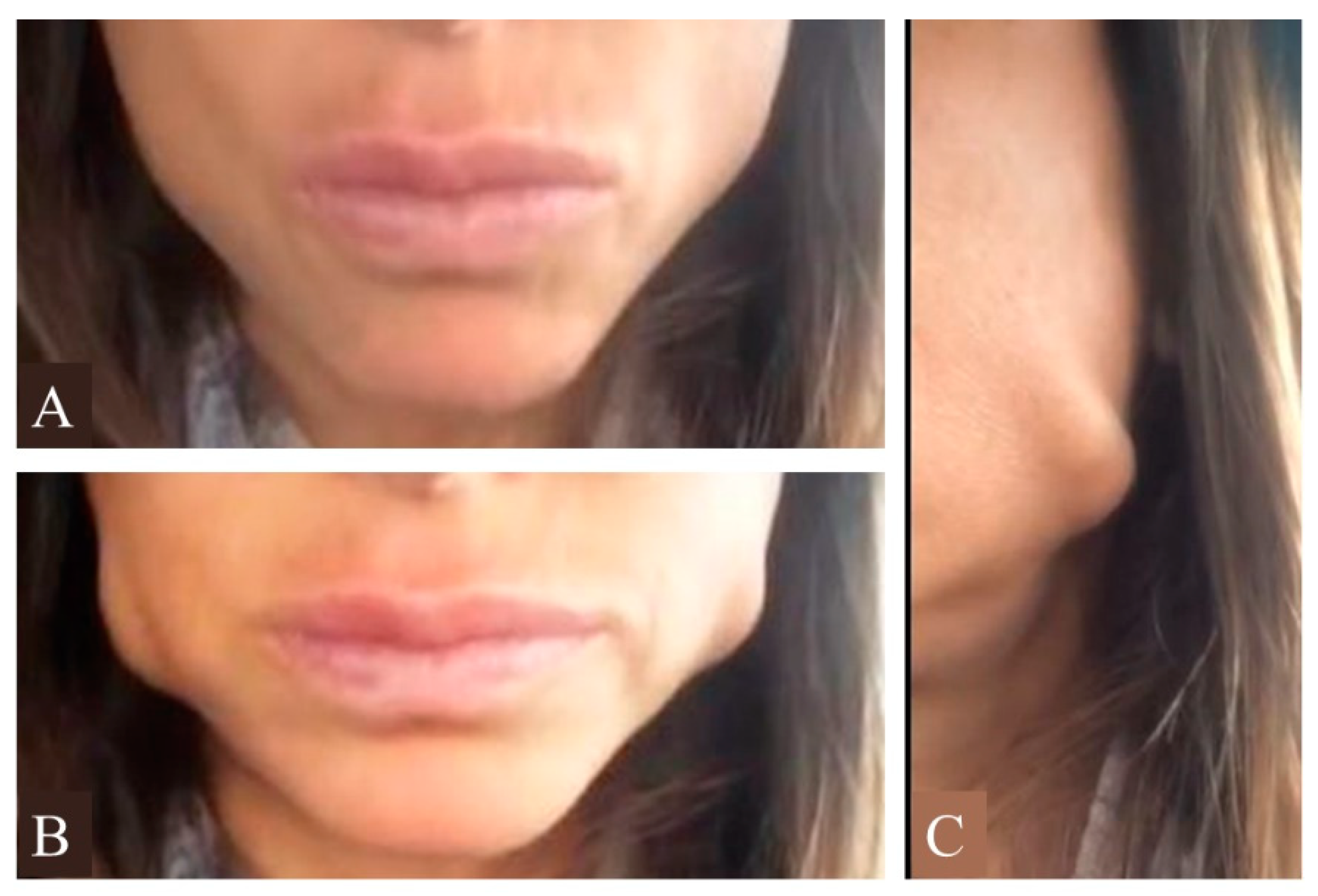 Image Bà Trương Mỹ Lan image beautiful image beautiful image beautiful image beautiful image beautiful image beautiful image beautiful image beautiful image beautiful - Biphasic Injection for Masseter Muscle Reduction with Botulinum Toxin