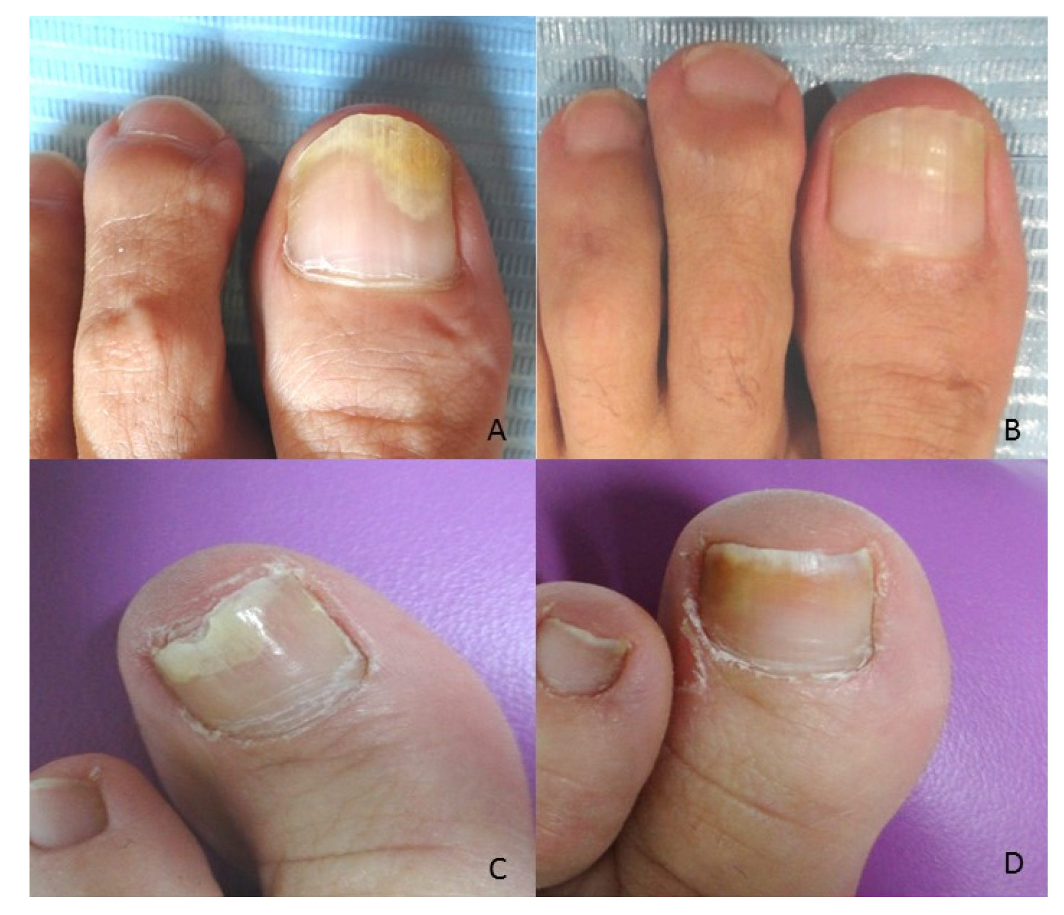 Applied Sciences | Free Full-Text | Quantitative Evaluation of the Clinical Evolution of Traumatic Onycholysis after Laser Treatment Applied Sciences | Free Full-Text | Quantitative Evaluation of the Clinical Evolution of Traumatic Onycholysis after Laser Treatment