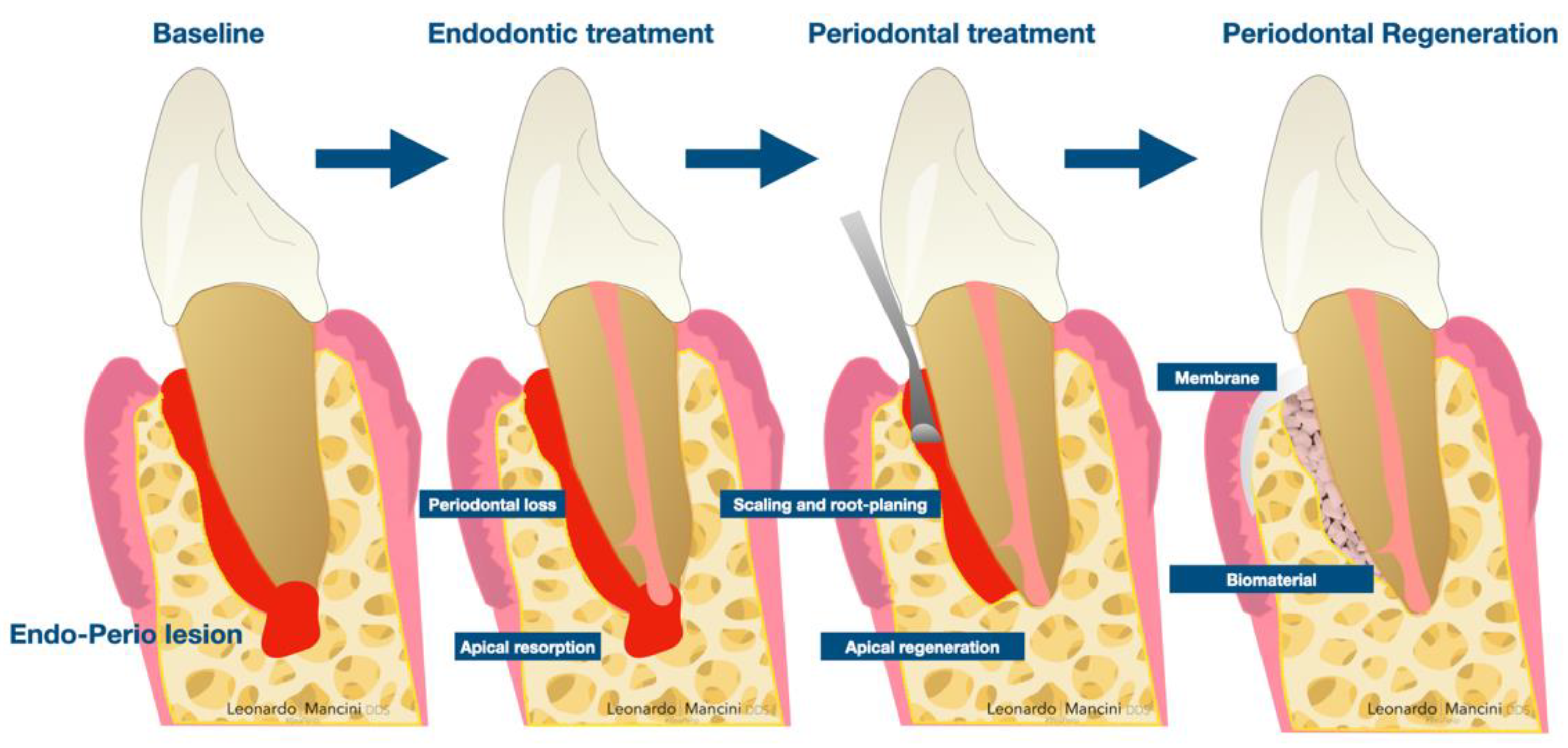 Applied Sciences Free FullText PlateletRich Fibrin A Viable