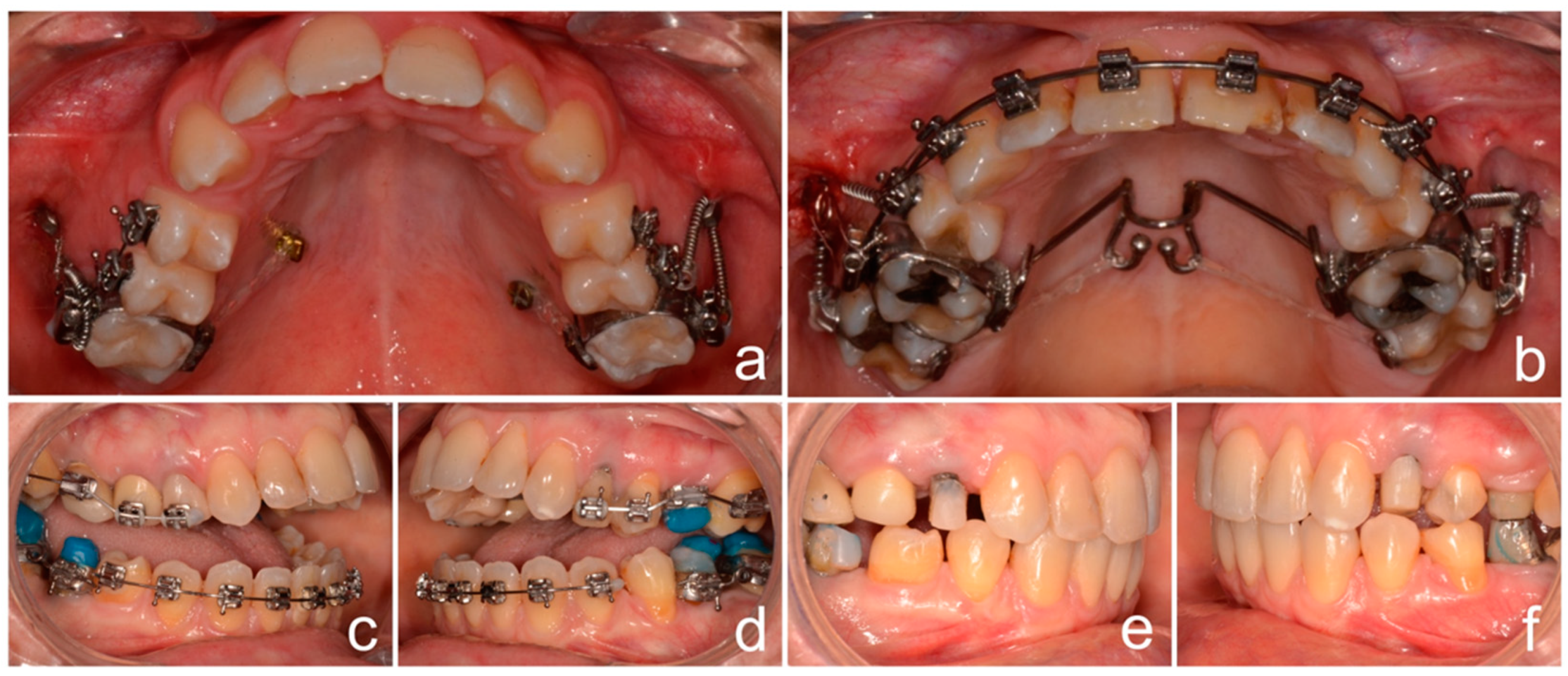 Tmj mouth splint discount