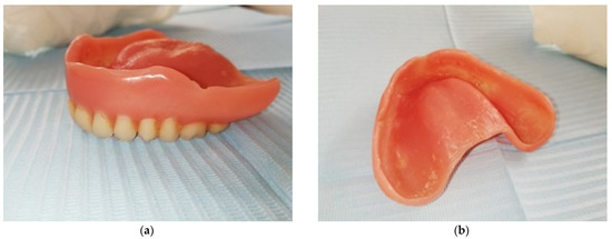 Flabby Ridge, a Challenge for Making Complete Dentures