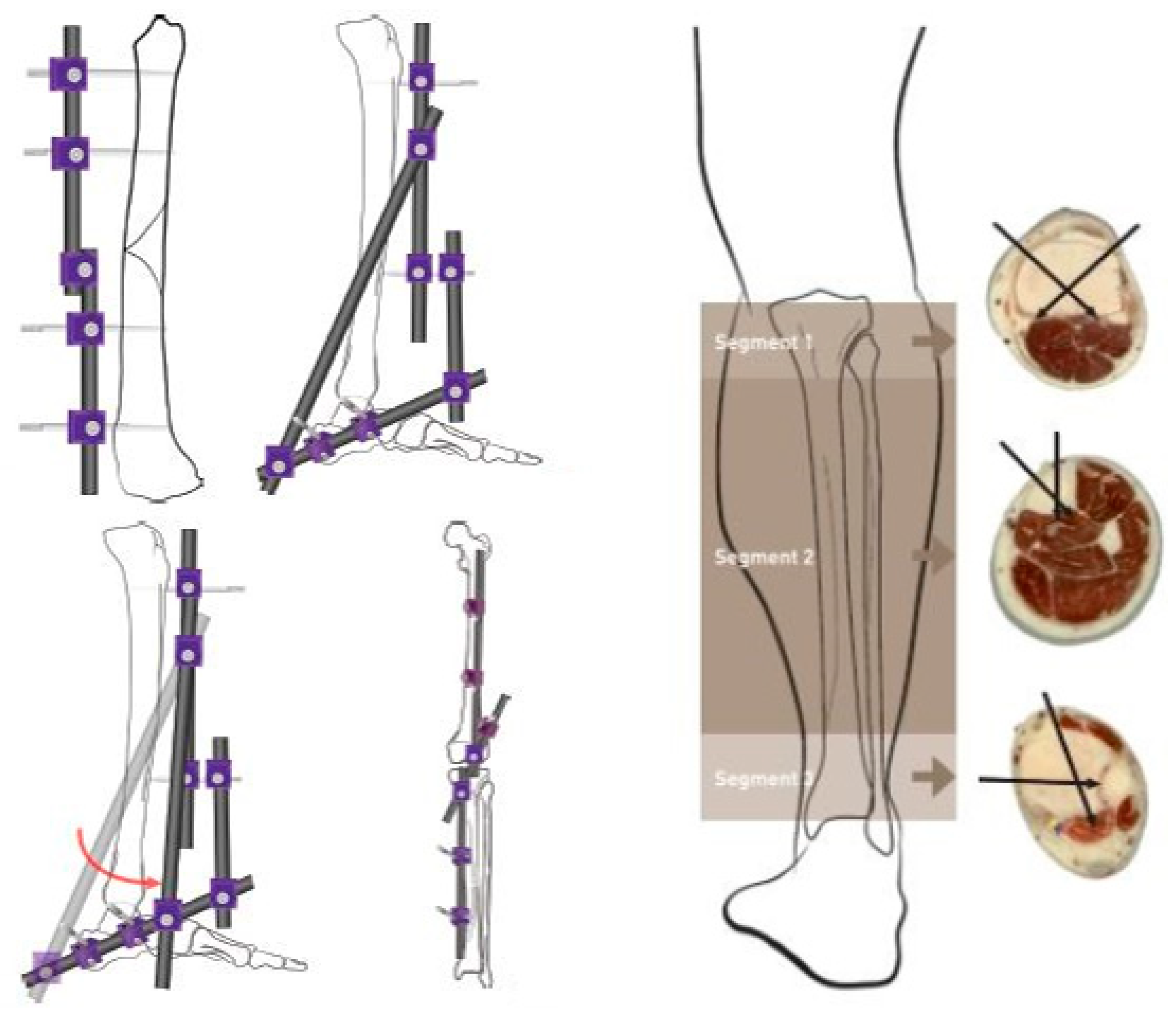 Wholesale Tibia Fixator, Wholesale Tibia Fixator Manufacturers