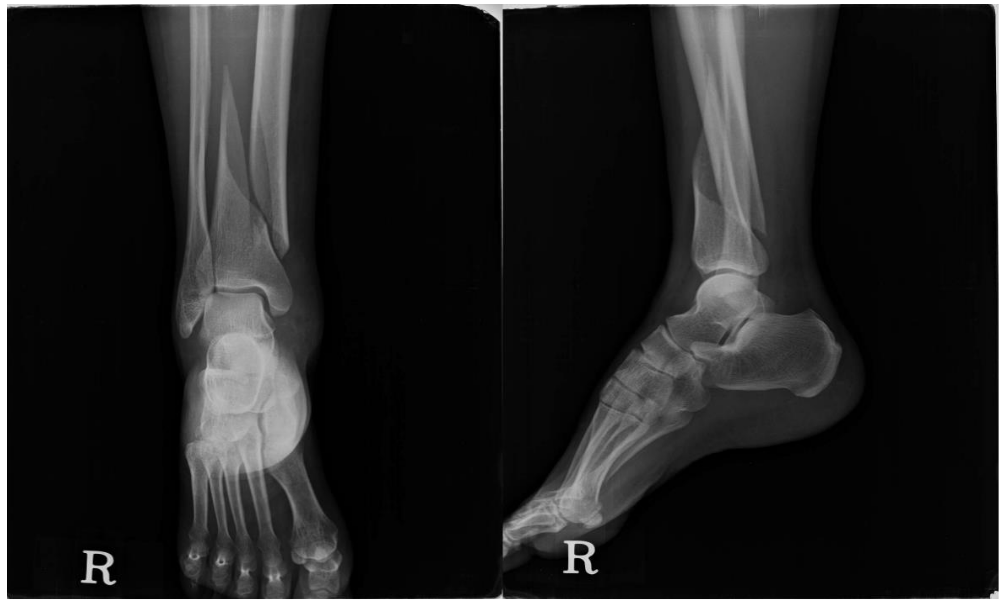 fractured ankle x ray