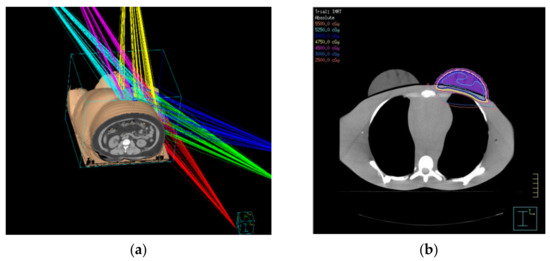 Midplane Radiotherapy A Dosimetric Analysis of Reduction Cardiac Dose with Lead Shielding in ...