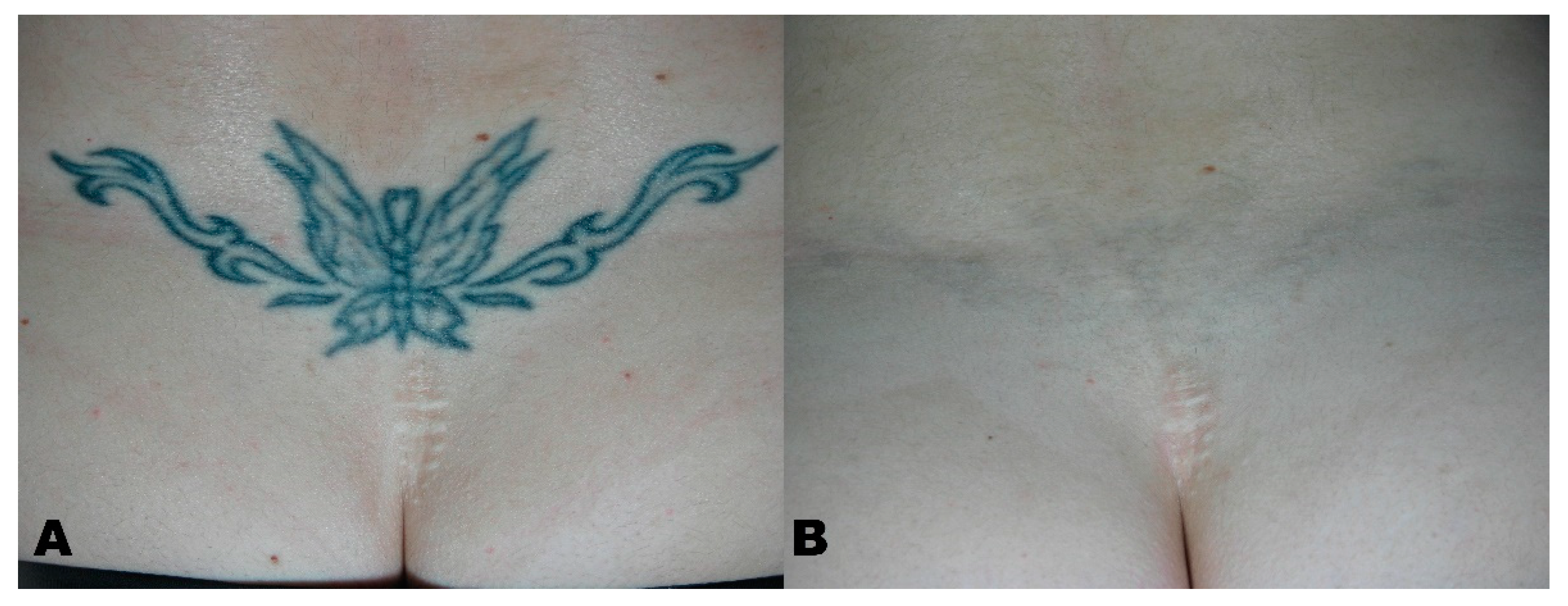 My tattoo removal experience — Beauty and the blonde