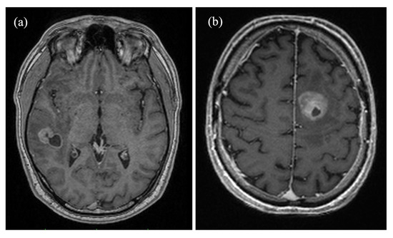 Automated detection of brain metastases on non-enhanced CT using