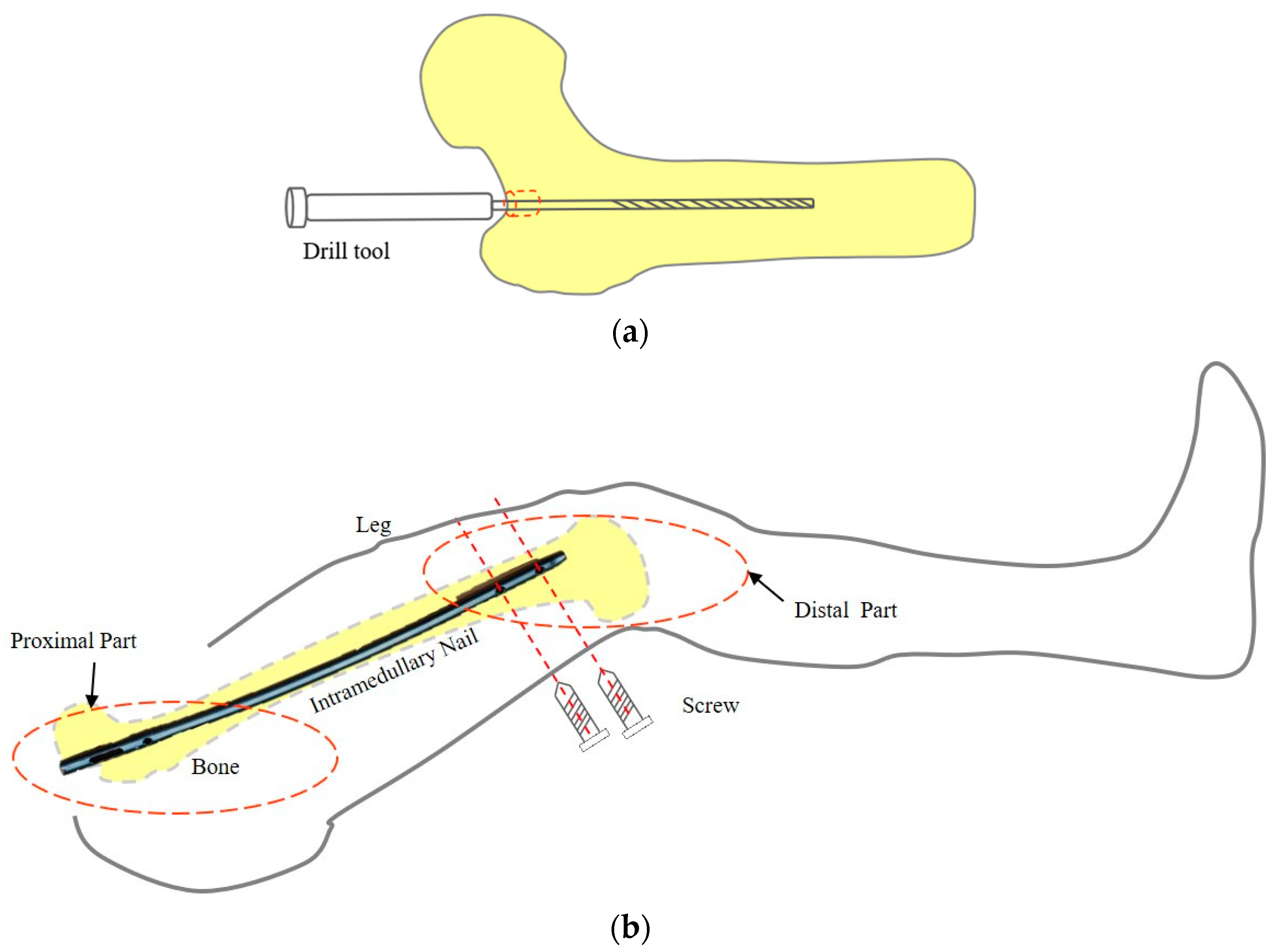Ankle Interlocking Nail-Intramedullary Nail-Stars health - medical equipment