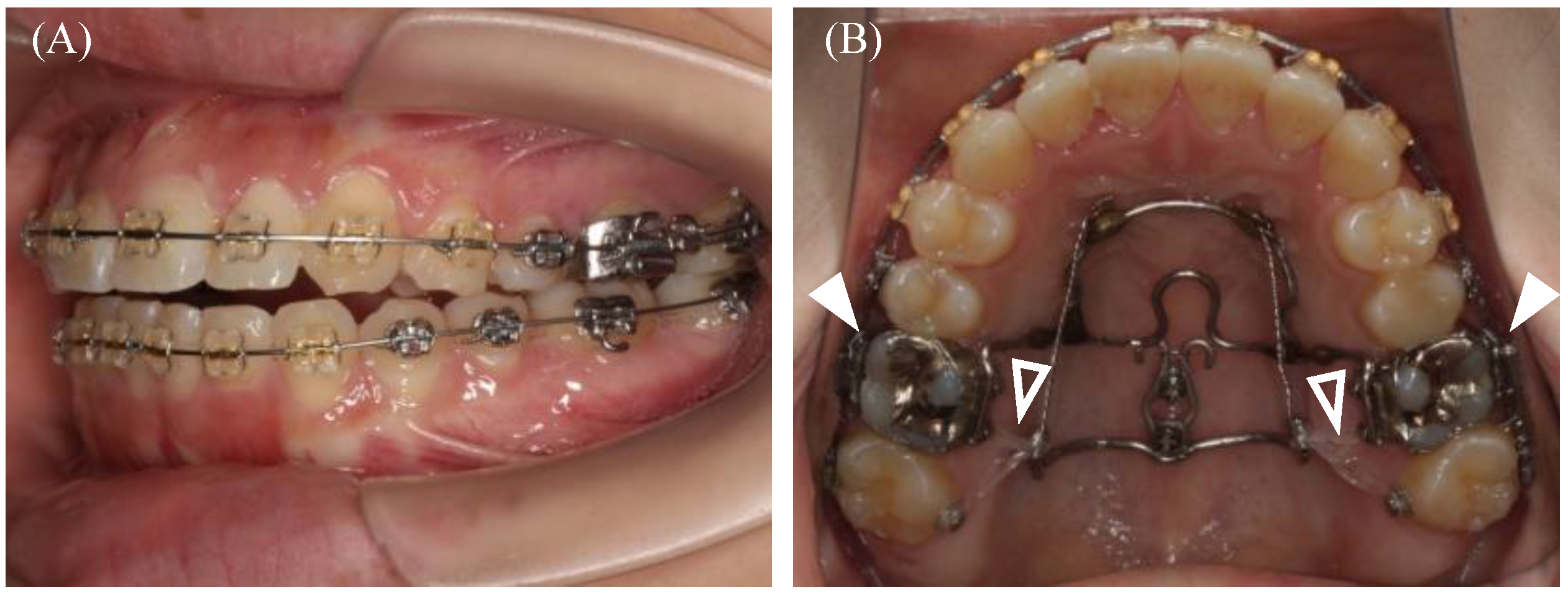 Placement of surgical hooks, completion of presurgical orthodontics.