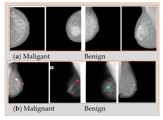 Breast Cancer Detection Using Mammogram Images with Improved Multi ...