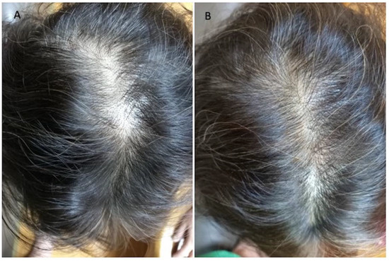 Applied Sciences | Free Full-Text | Regenerative Biotechnologies in Plastic Surgery: A Multicentric, Retrospective, Case-Series Study on the Use of Micro-Needling with Low-Level Light/Laser Therapy as a Hair Growth Boost in Patients Applied Sciences | Free Full-Text | Regenerative Biotechnologies in Plastic Surgery: A Multicentric, Retrospective, Case-Series Study on the Use of Micro-Needling with Low-Level Light/Laser Therapy as a Hair Growth Boost in Patients