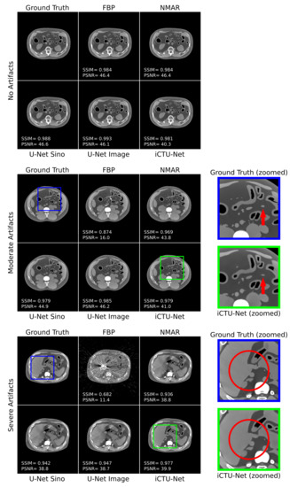End-to-End Deep Learning CT Image Reconstruction for Metal Artifact ...