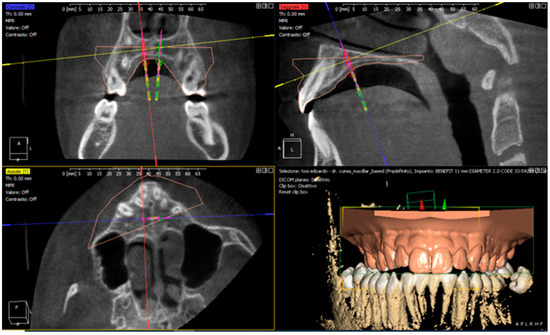 Properties of CAD/CAM 3D Printing Dental Materials and Their Clinical ...
