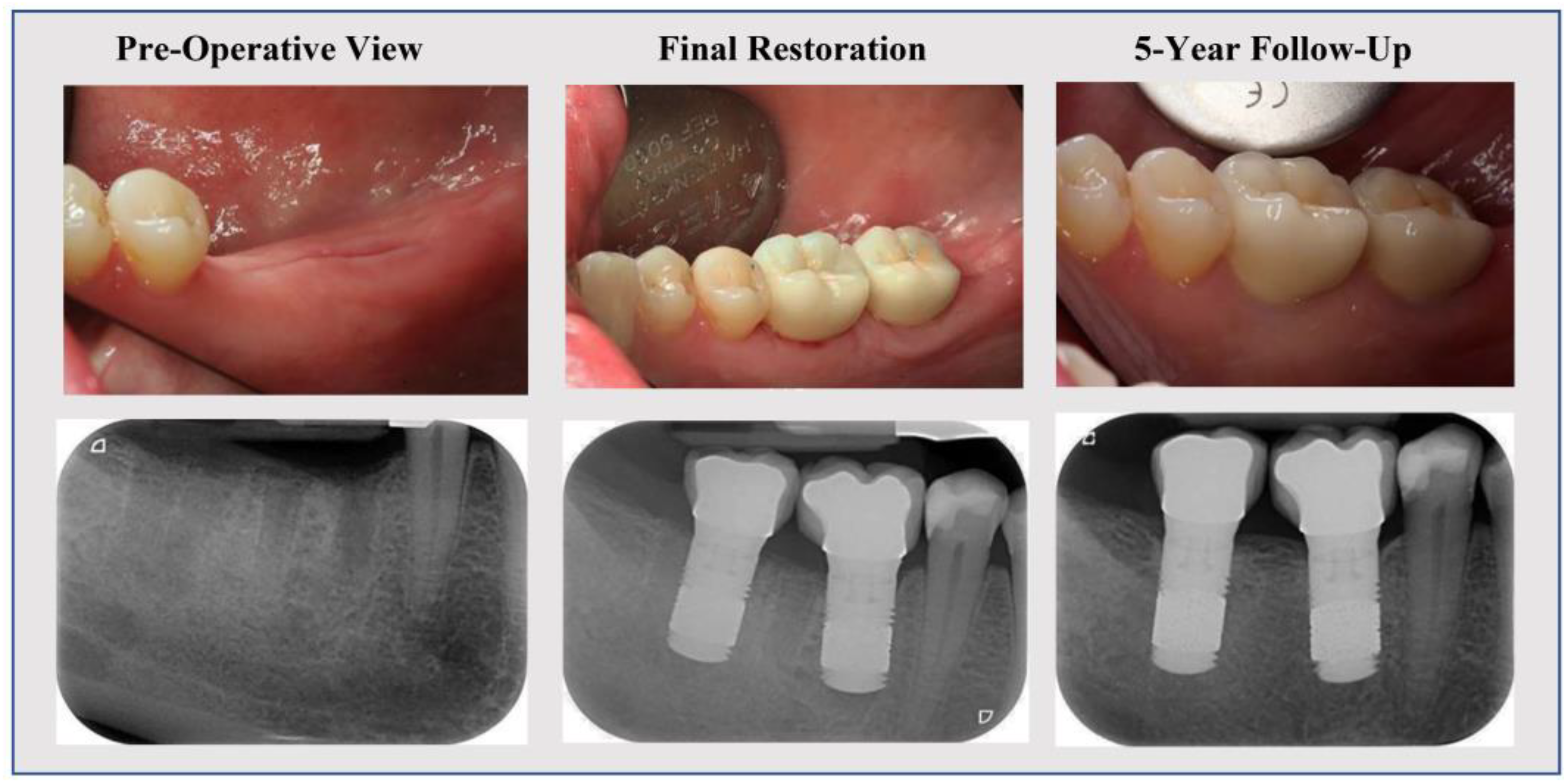 free dental implants clinical trials 2020 Amberly Mcclintock