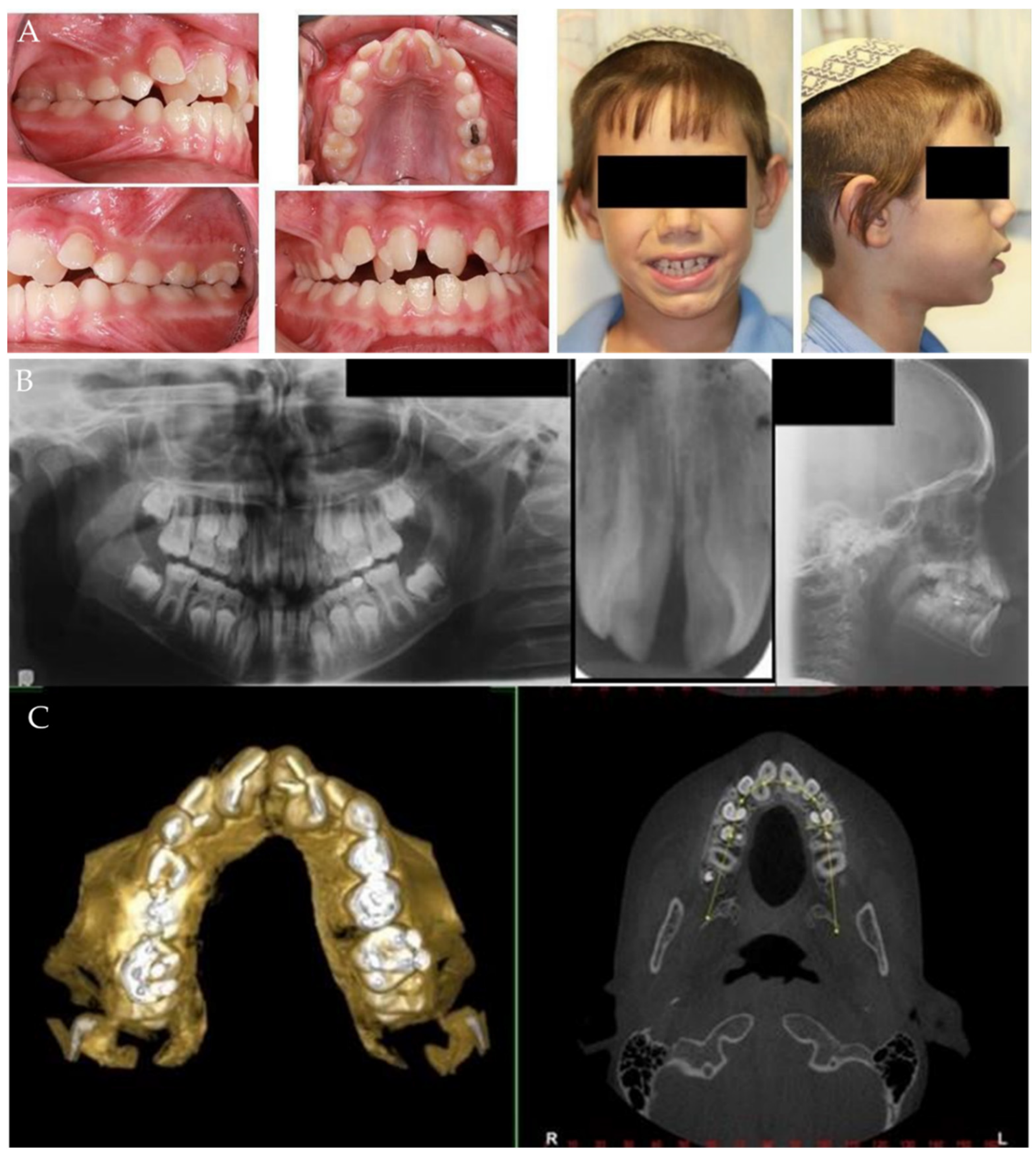 Applied Sciences | Free Full-Text | Geminated Maxillary Incisors: The  Success of an Orthodontic Conservative Approach: 15 Years Follow-Up Study