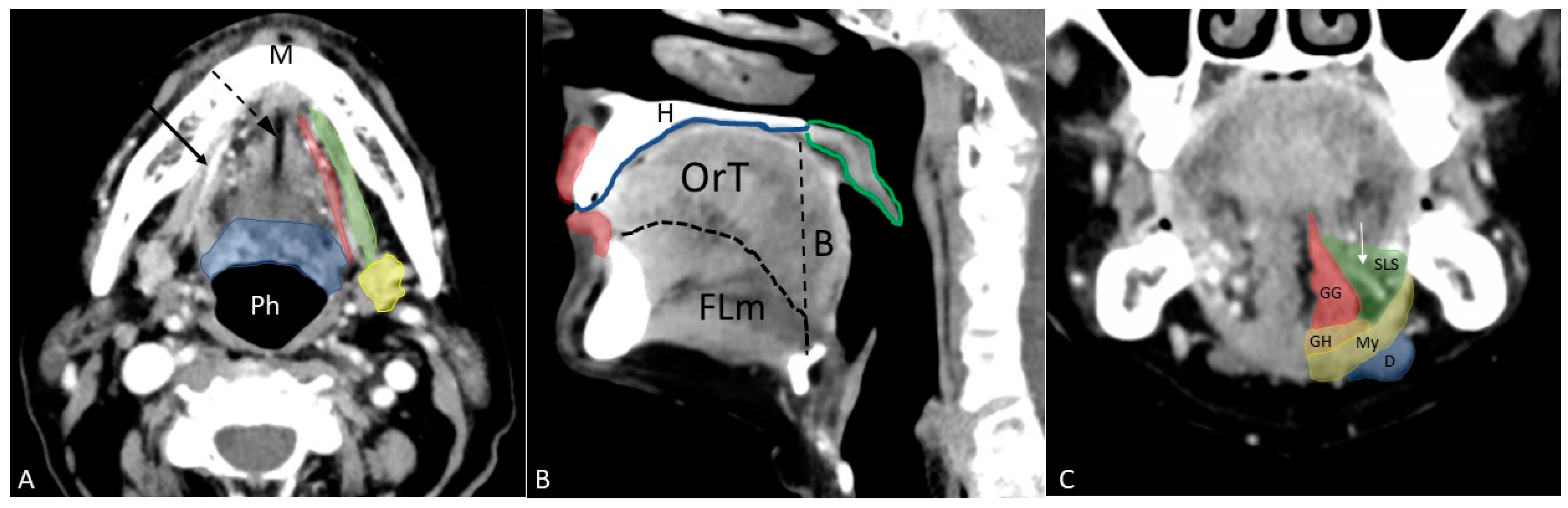 Floor Of Mouth Cancer Staging Radiology