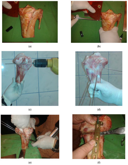 大腿骨近位部骨折 Surgical technique m3電子書籍 | 整形外科Surgical Technique BOOKS12 大腿骨近位部骨折