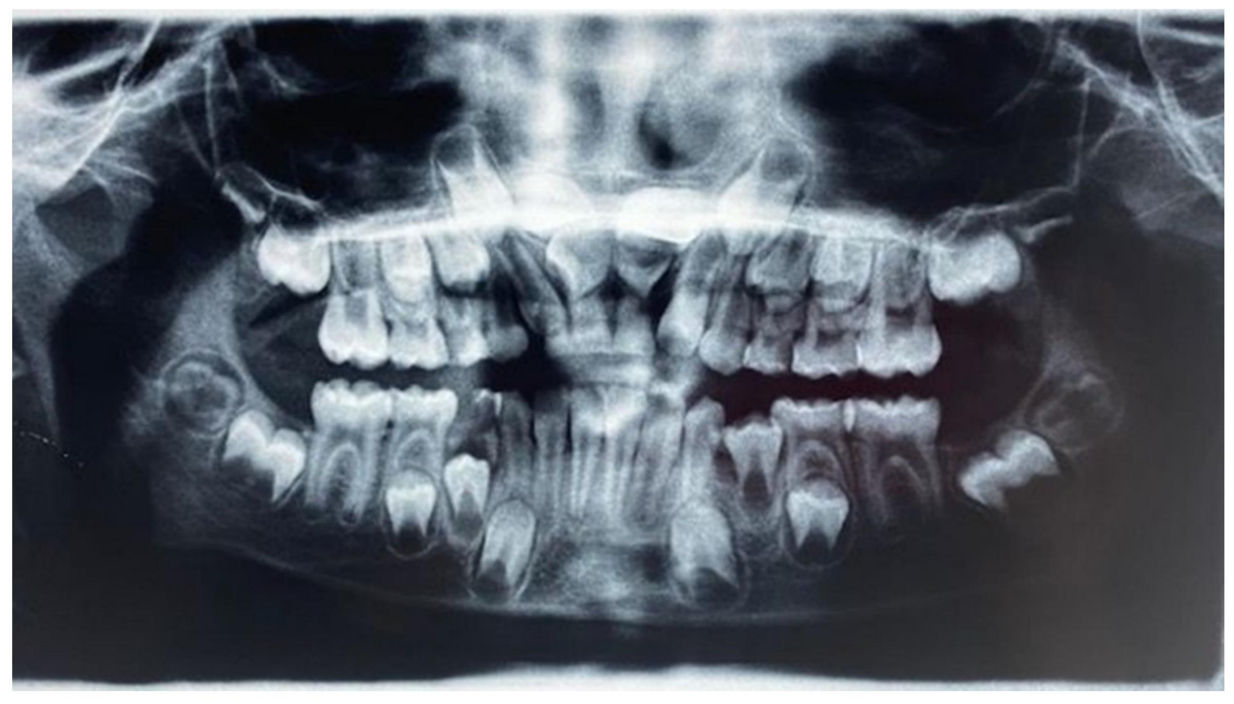 Applied Sciences Free FullText Impacted Central Incisors in the