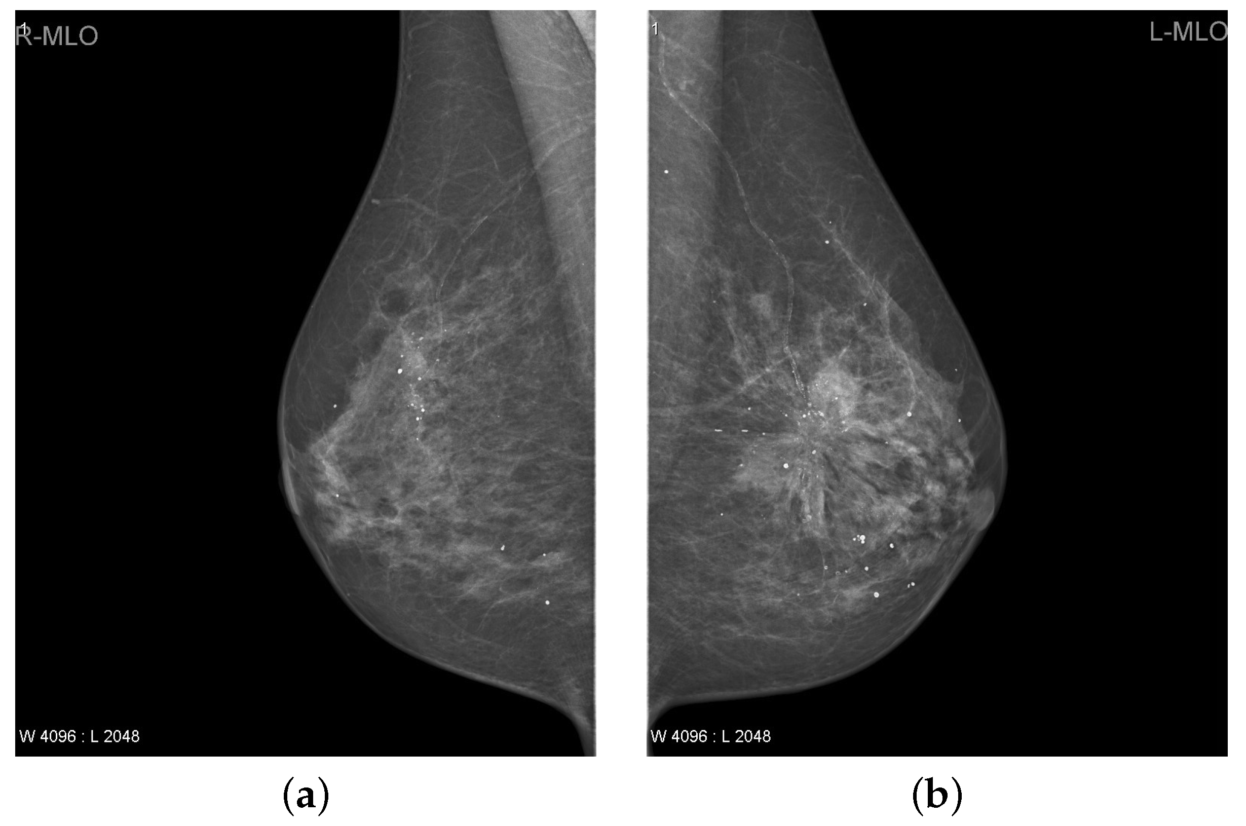 breast cancer digital mammogram