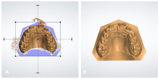 Application of the Digital Workflow in Orofacial Orthopedics and ...