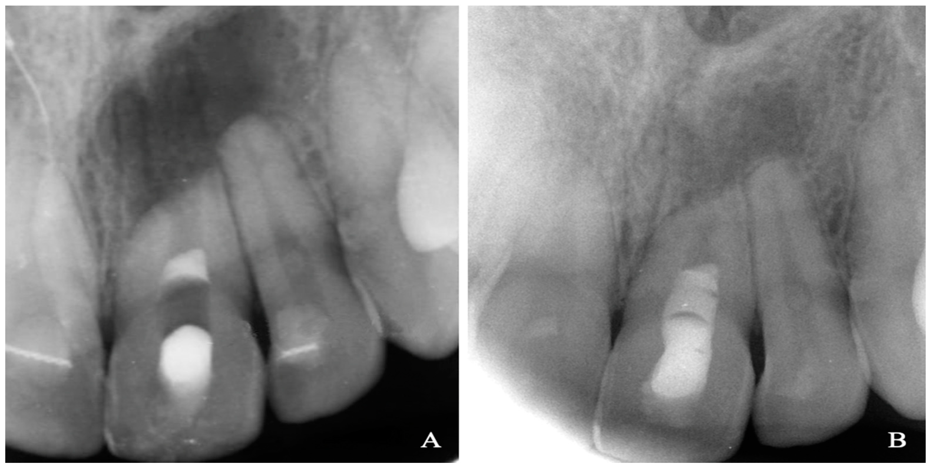 Representative images of a (A) 3-mm and (B) 6-mm apical plug and