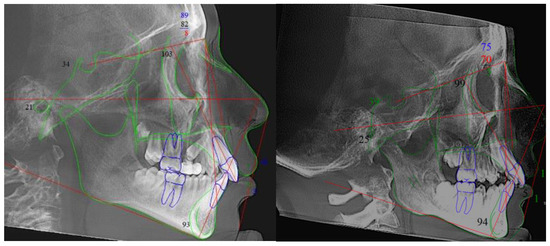 A 3D CBCT Analysis of Airway and Cephalometric Values in Patients ...