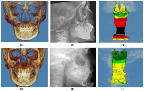 A 3D CBCT Analysis of Airway and Cephalometric Values in Patients ...