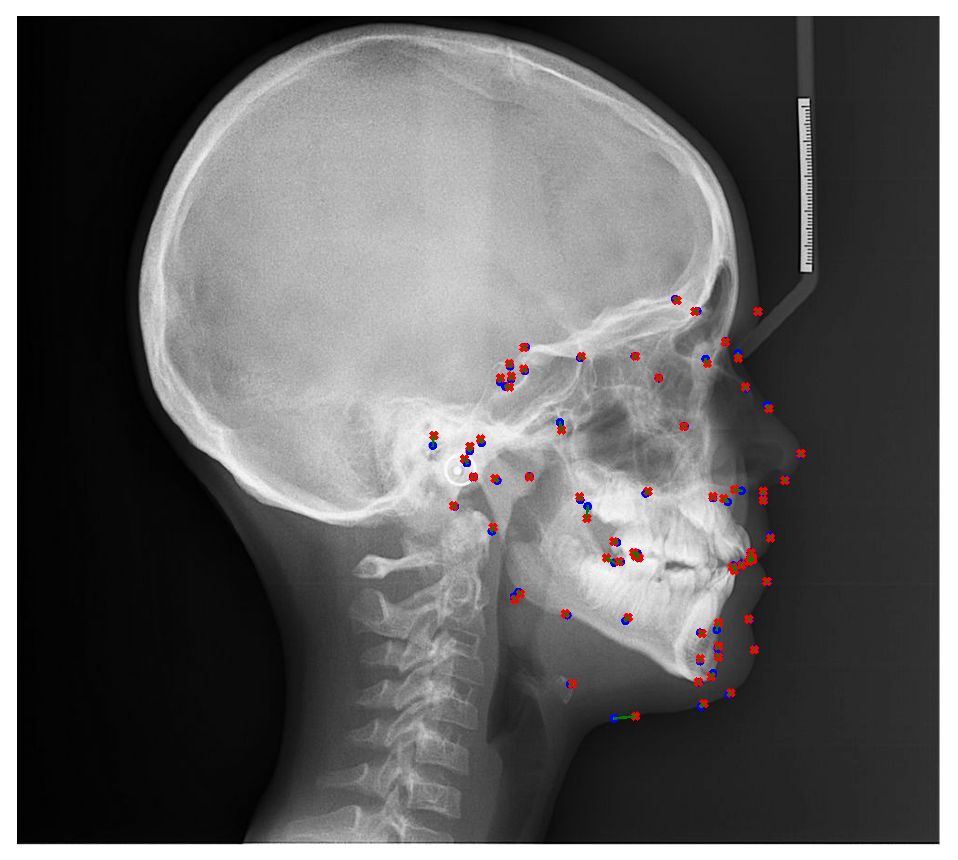 Radiographic Cephalometry 歯科　本　矯正 cephalometry-ceph-tooth-dental
