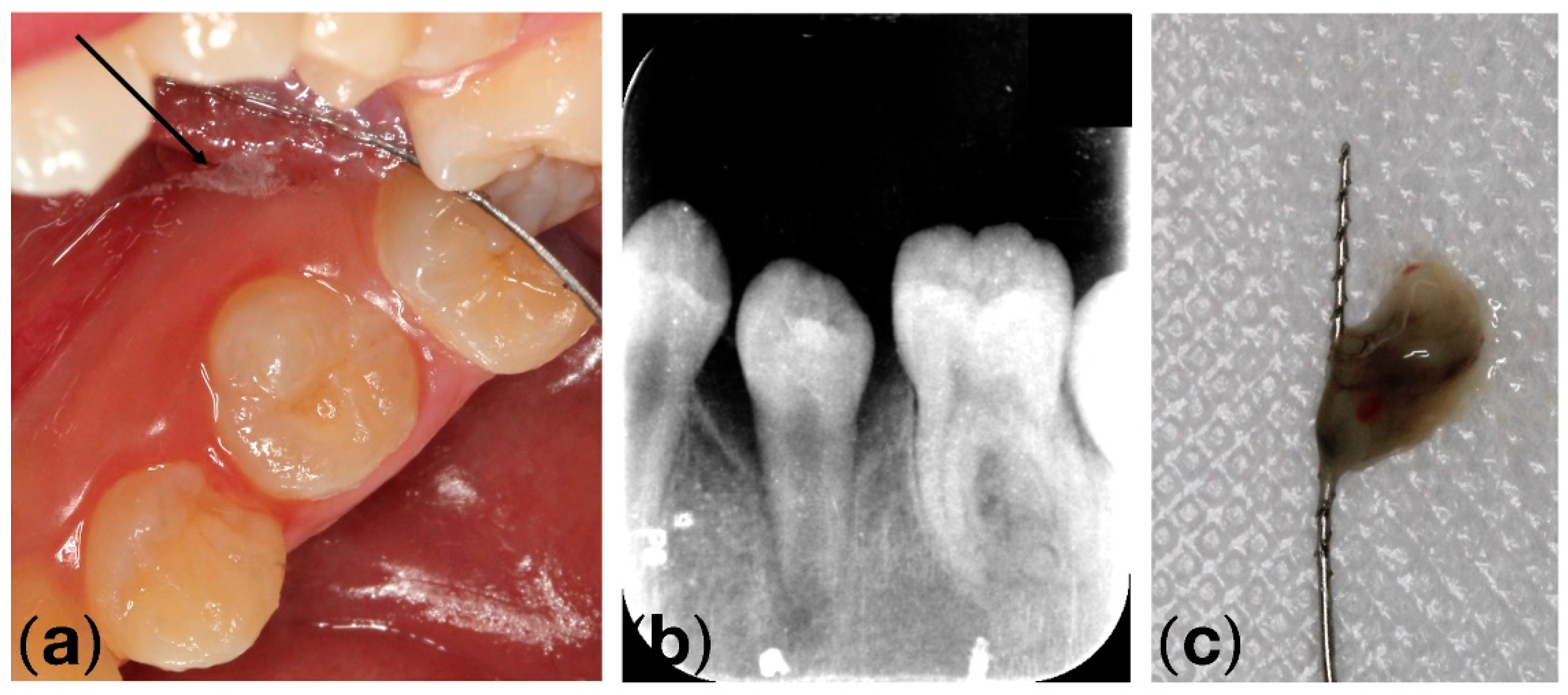 Root Canal Disinfection Using Highly Effective Aggregation-Induced