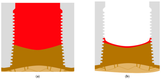 Peri-Implantitis: A New Definition Proposal Based on