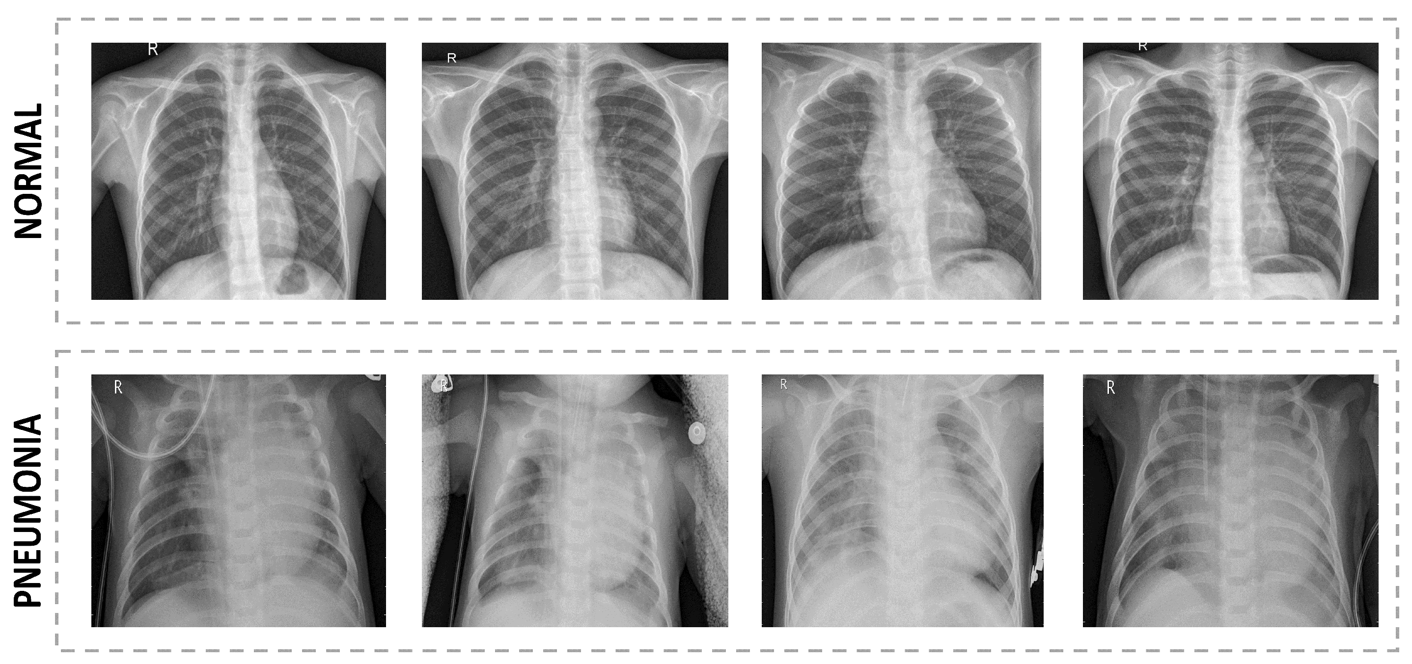 Applied Sciences | Free Full-Text | Pneumonia Detection on Chest X-ray ...