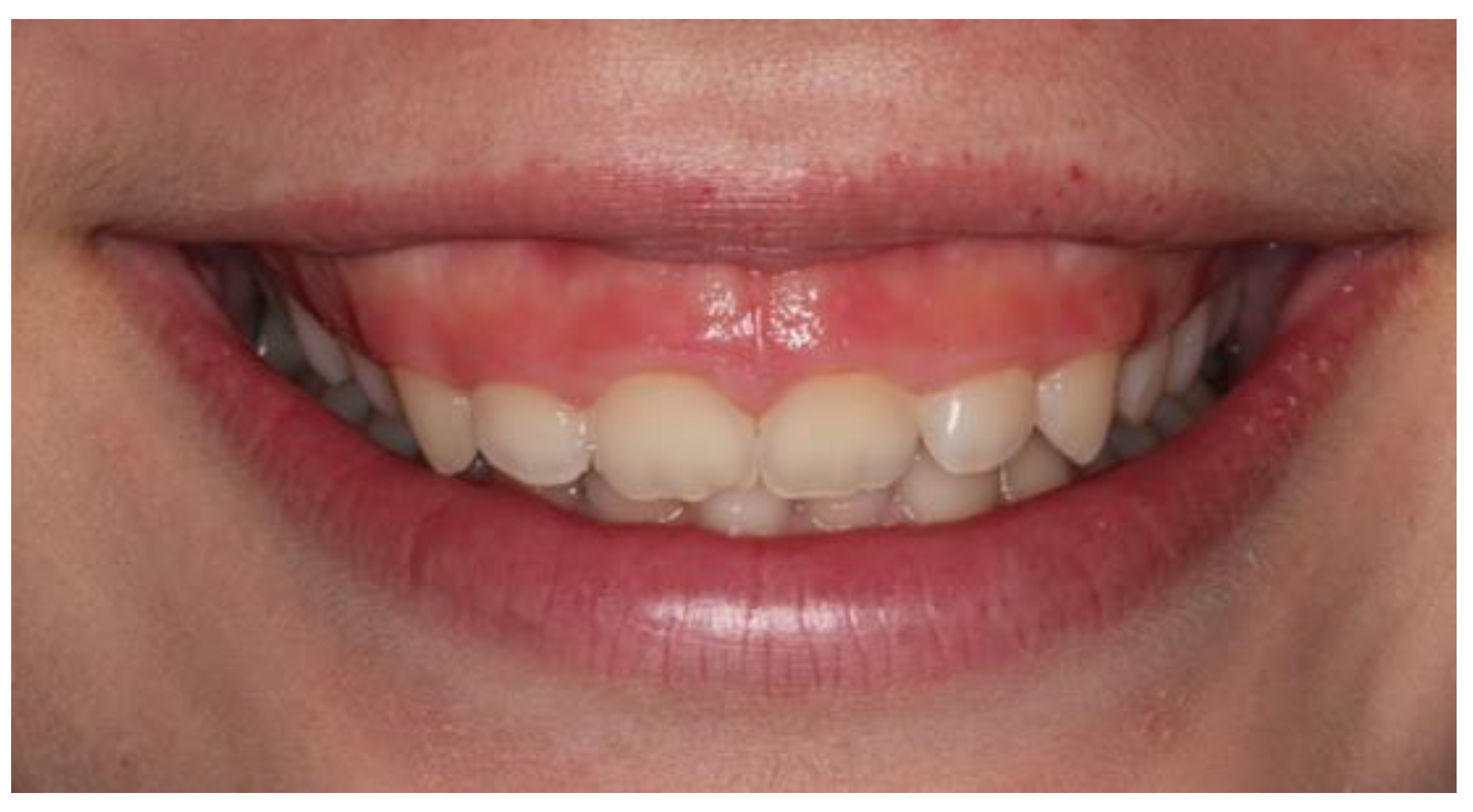 Deep Bite Treatment with Aligners A New Protocol