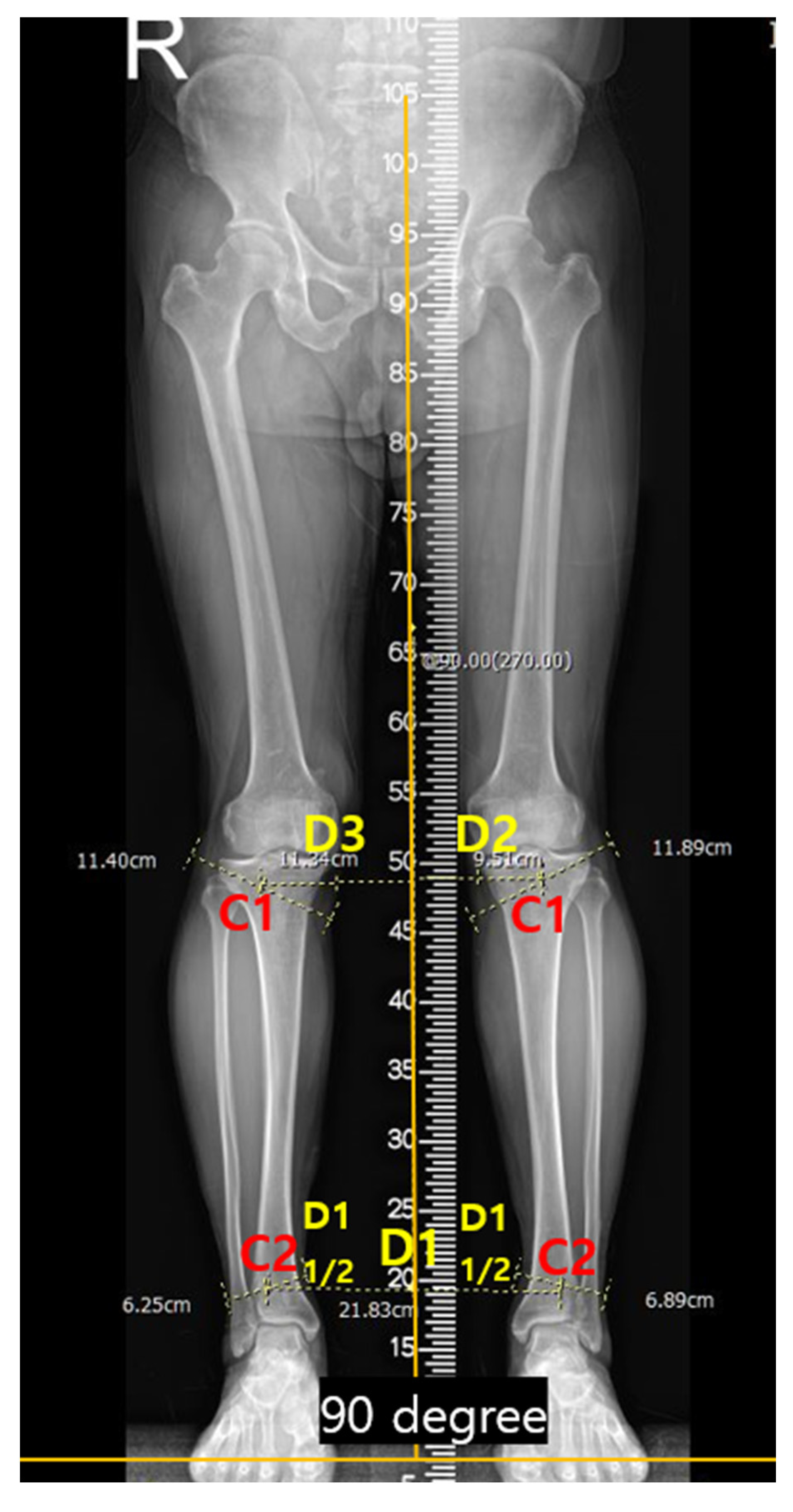 Measurement of Lower Extremity Alignment Using a Smartphone