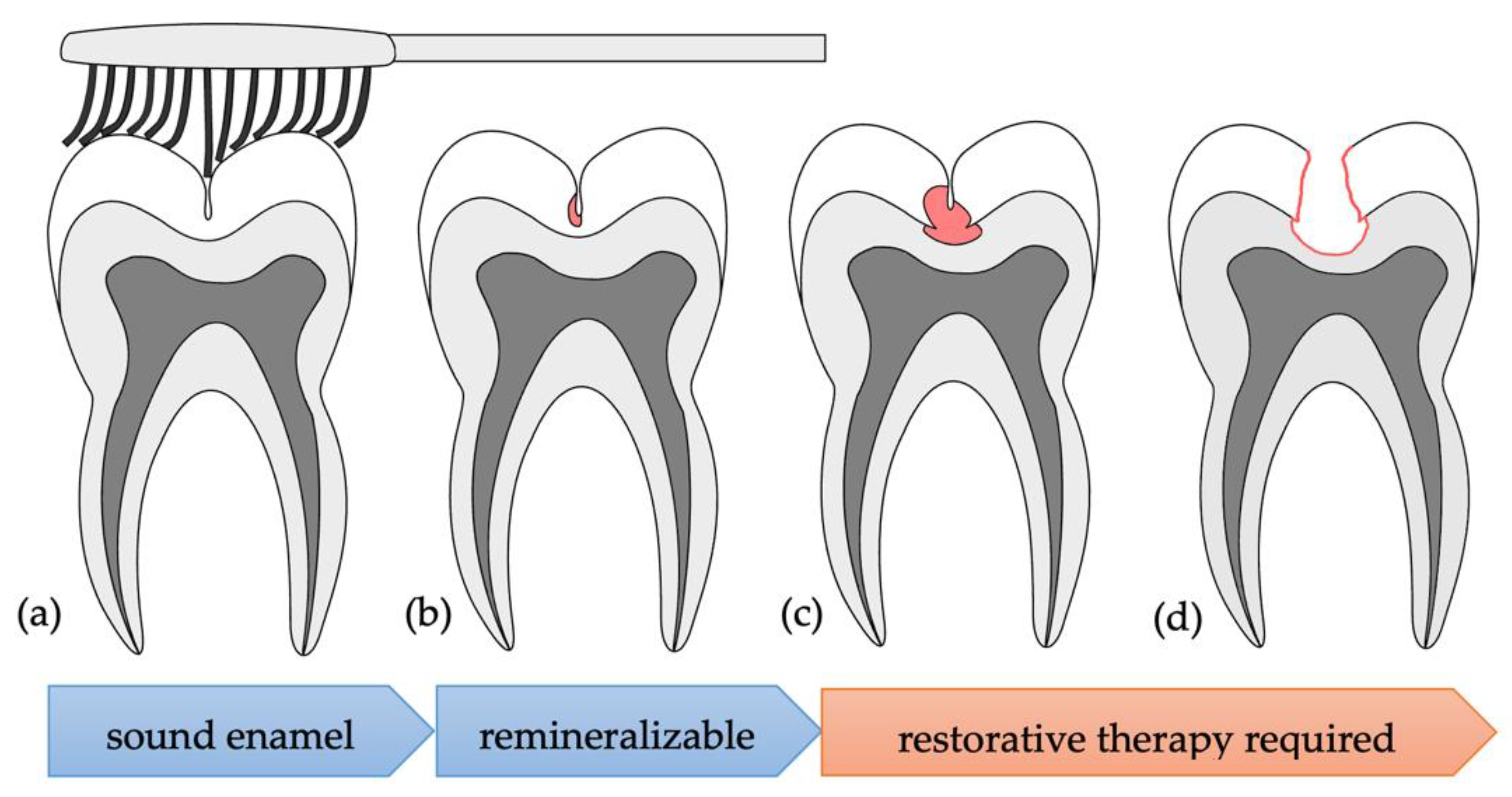 Applied Sciences Free FullText Differentiation of Occlusal Discolorations and Carious
