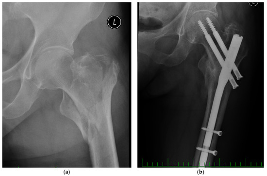 Applied Sciences | Free Full-Text | Biomechanical Assessment of Cannulated Nails for the Treatment of Proximal Femur Fractures Applied Sciences | Free Full-Text | Biomechanical Assessment of Cannulated Nails for the Treatment of Proximal Femur Fractures