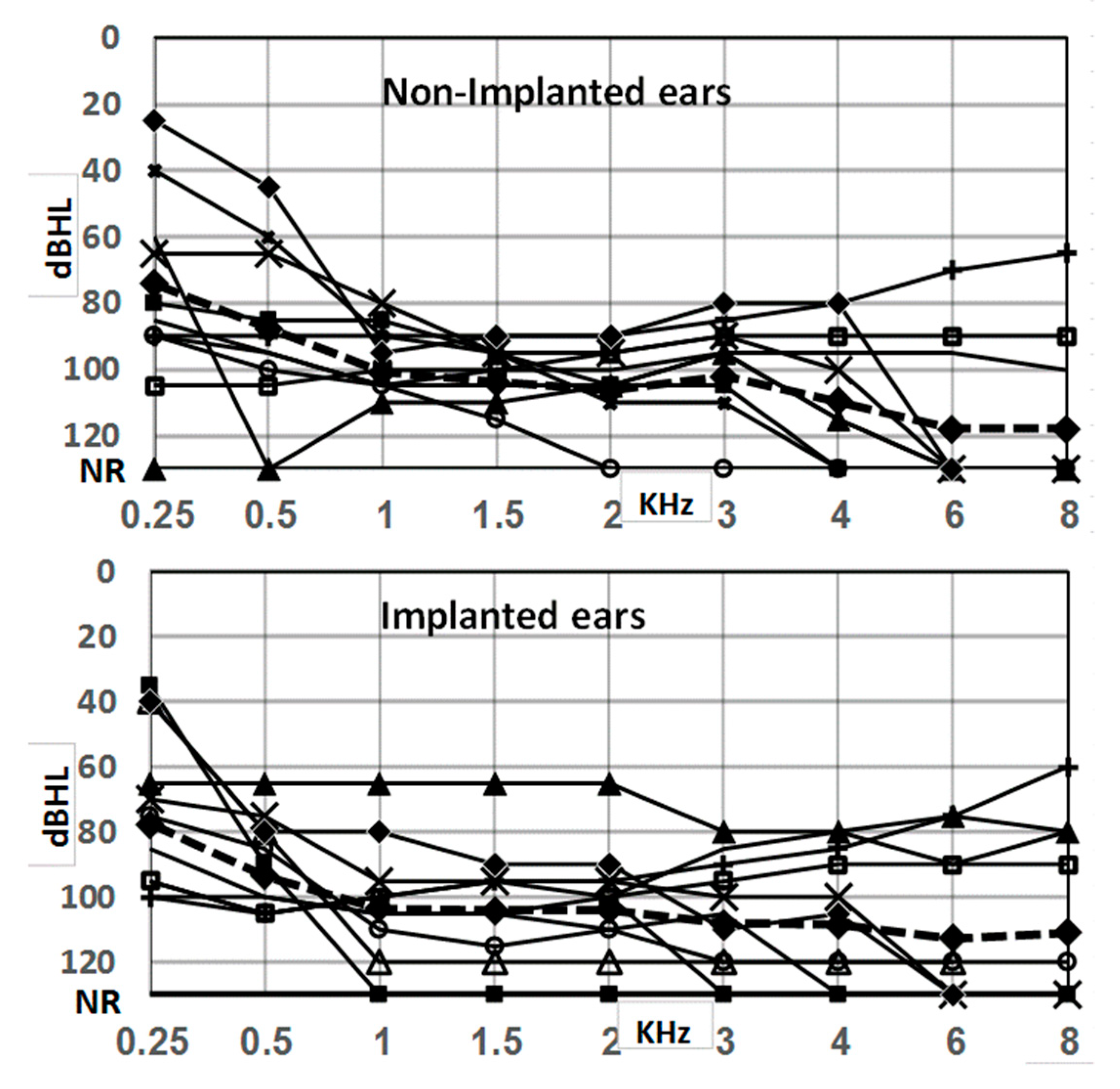 A diagram for plotting findings for tympanometry and acoustic