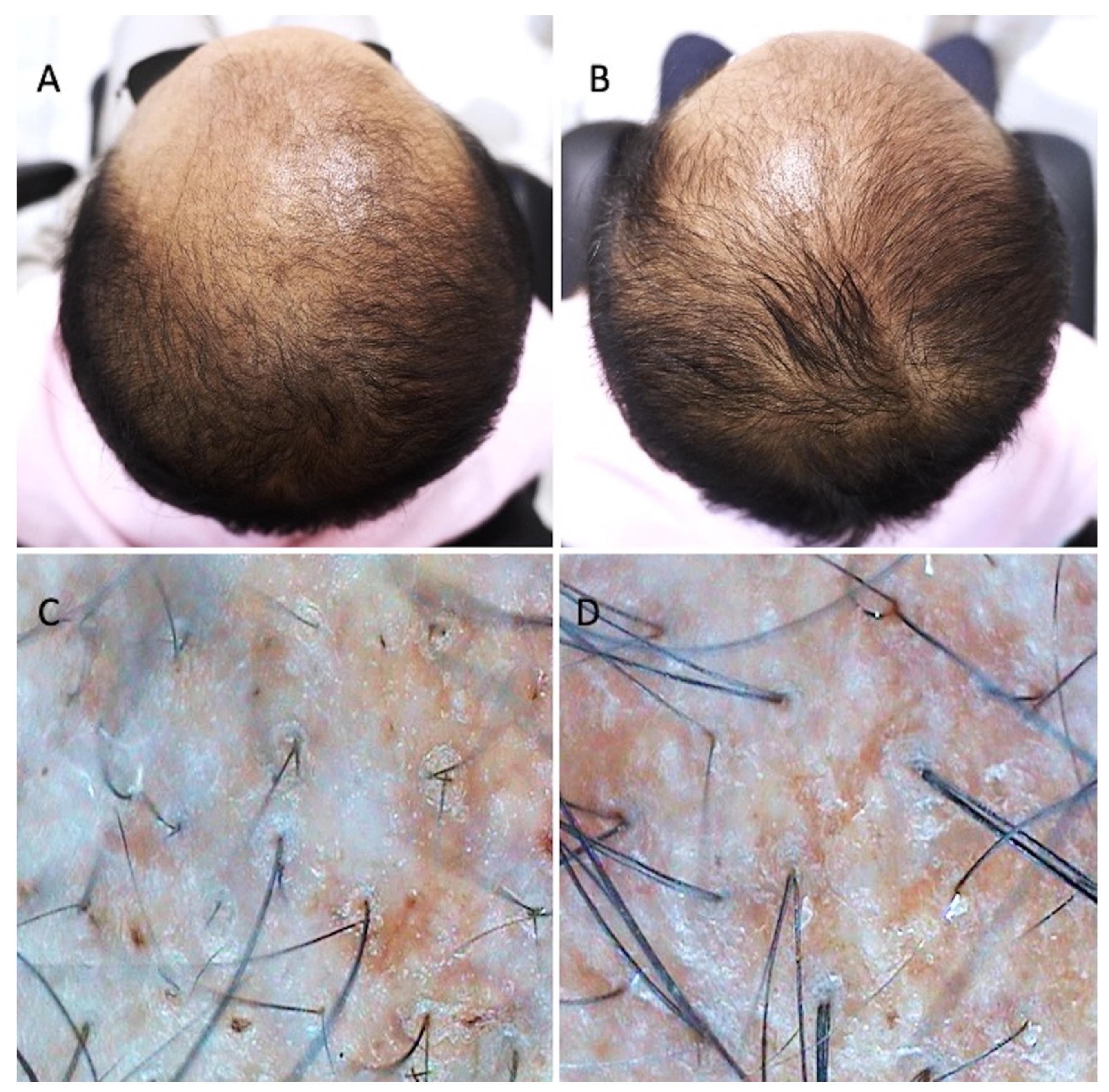 Applied Sciences | Free Full-Text | Hair Growth Booster Effects of Micro-Needling with Low-Level Led Therapy and Growth Factors on Subjects Treated with Finasteride® Applied Sciences | Free Full-Text | Hair Growth Booster Effects of Micro-Needling with Low-Level Led Therapy and Growth Factors on Subjects Treated with Finasteride®