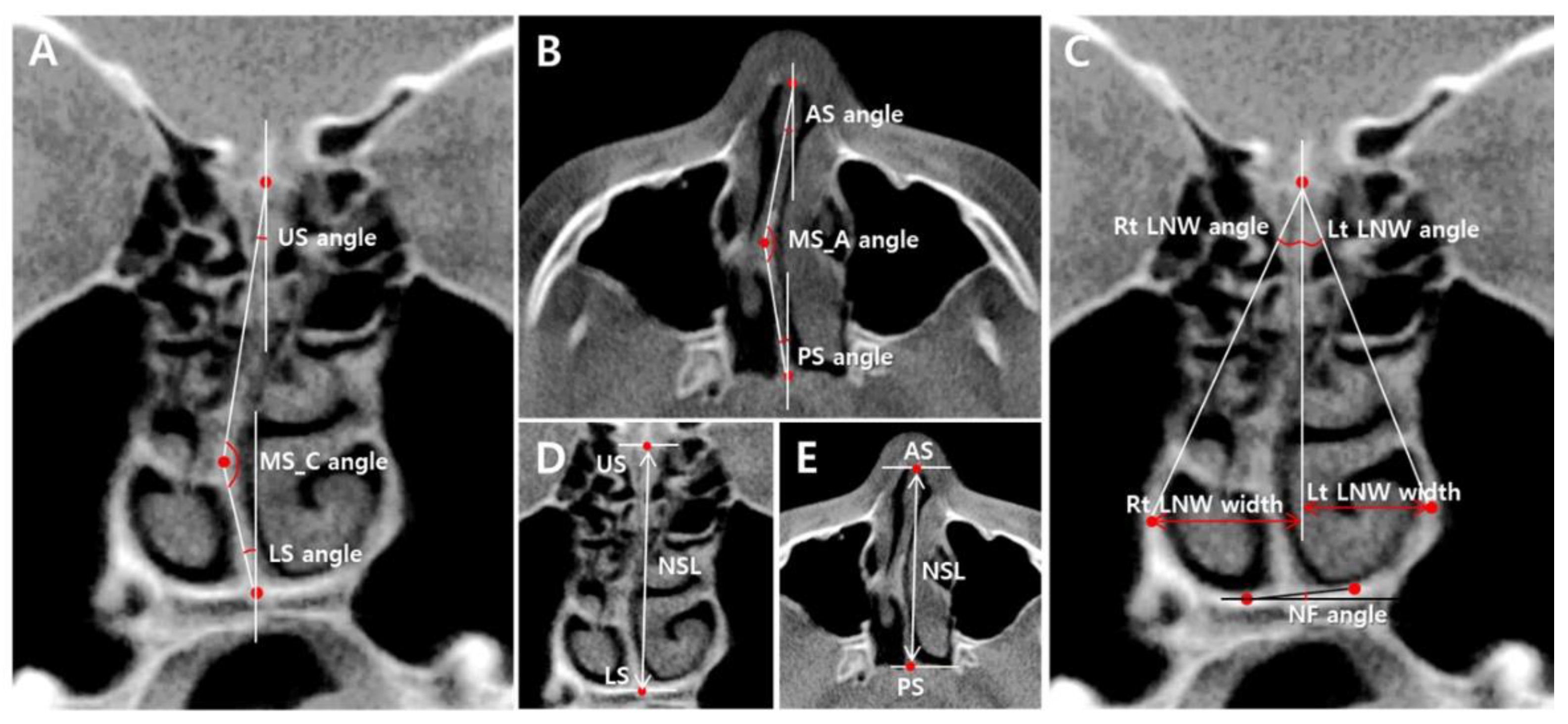 Applied Sciences Free FullText A CBCT Evaluation of Nasal Septal
