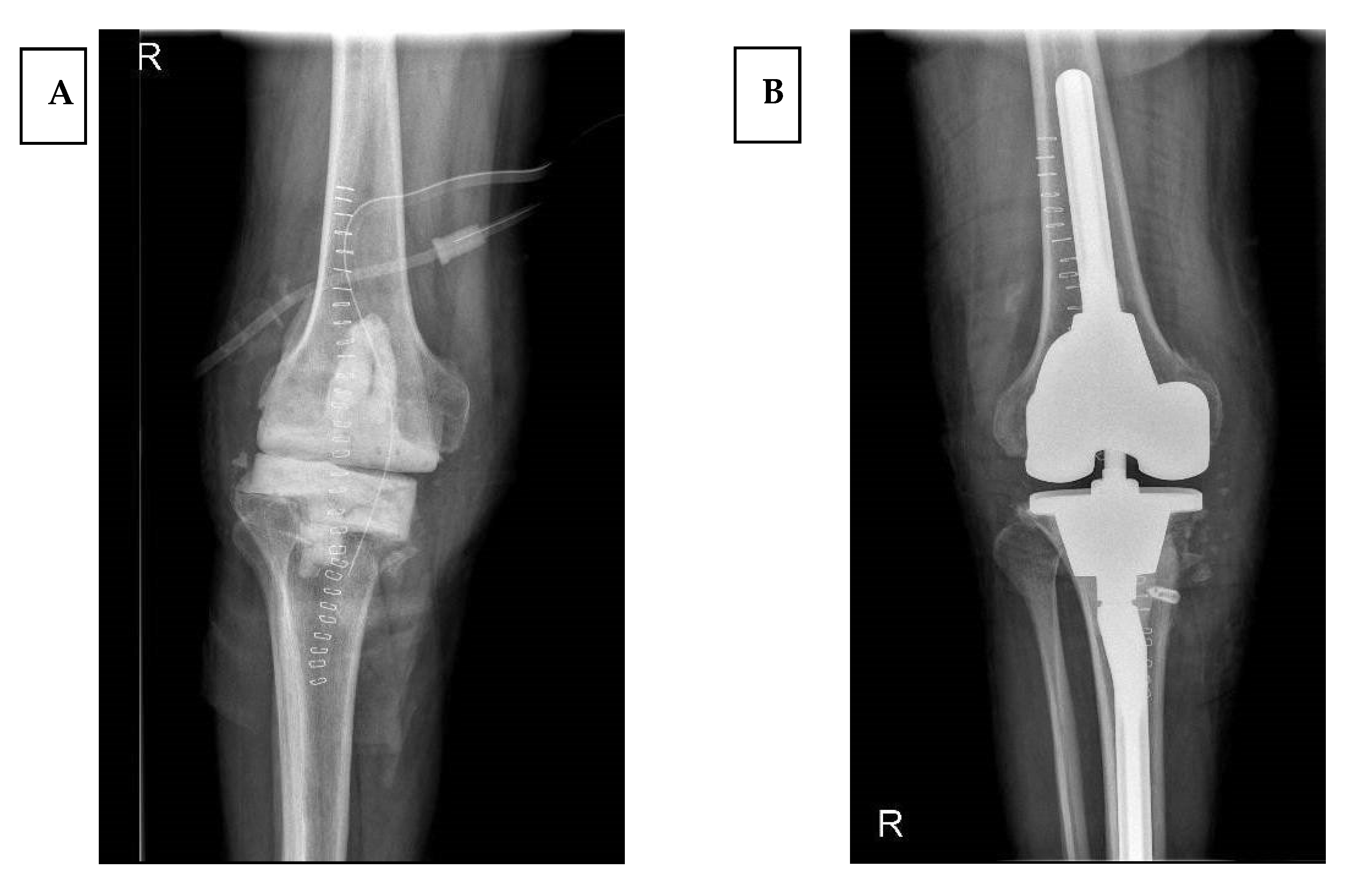 Hinged Knee Revision X Ray