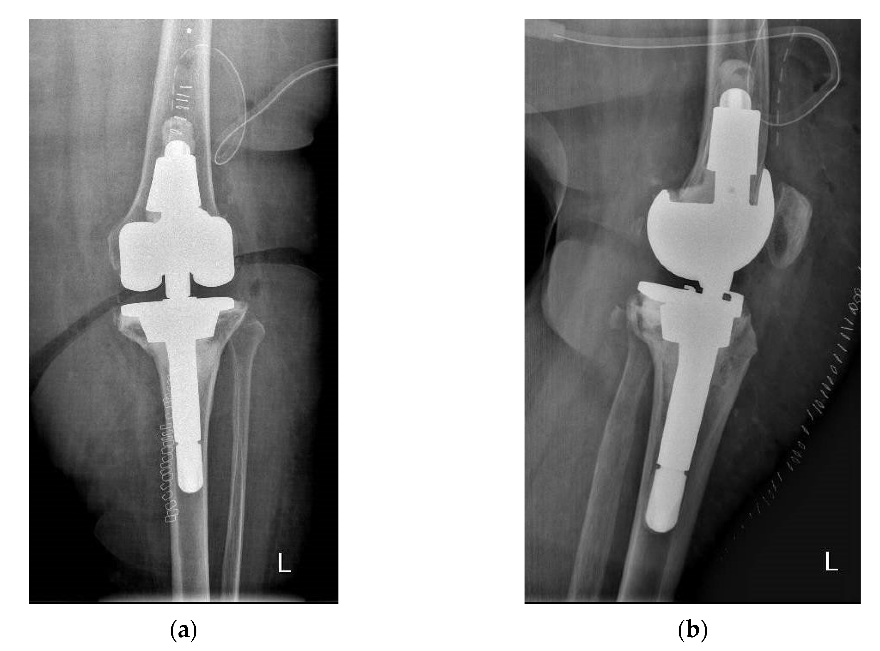 Applied Sciences Free FullText Clinical of Revision Total Knee Arthroplasty among